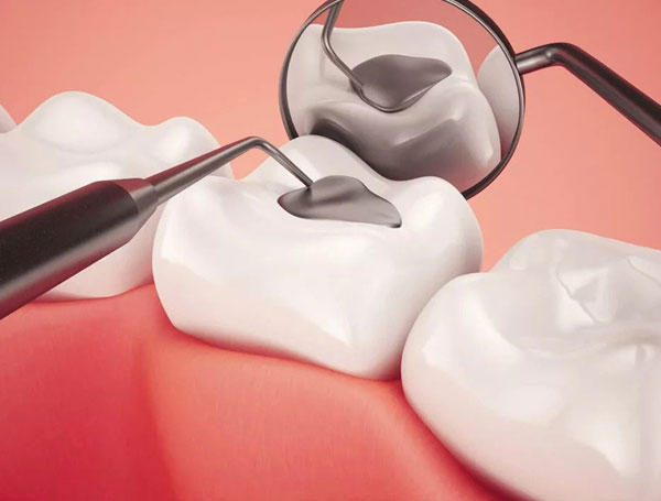 Dental Fillings