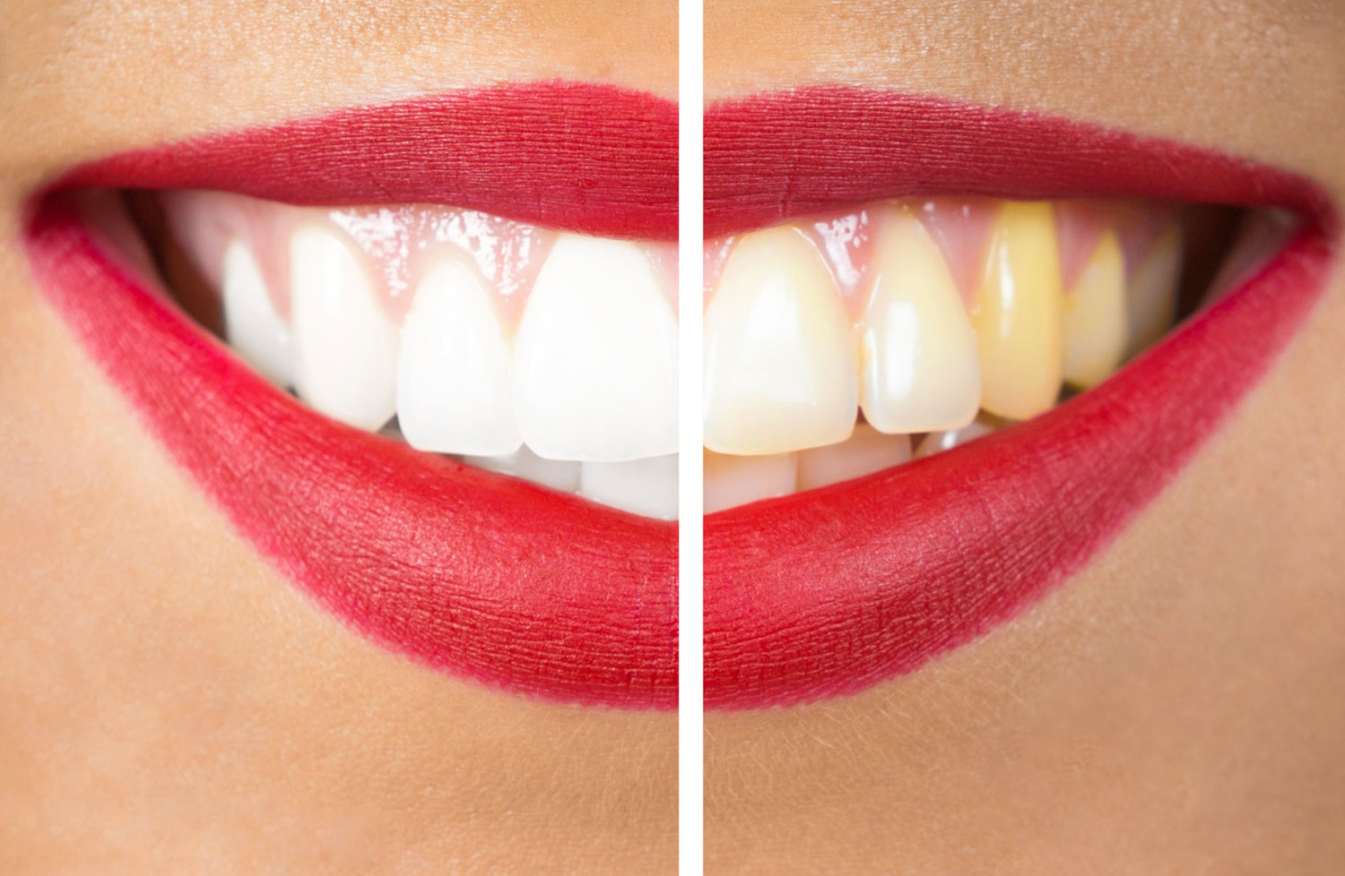 Zoom Teeth Whitening