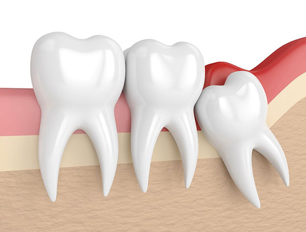 Tooth Extraction