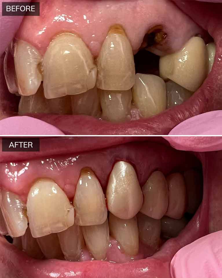 Before and after dental restoration showing improved tooth alignment and appearance at Lombardi Dental.