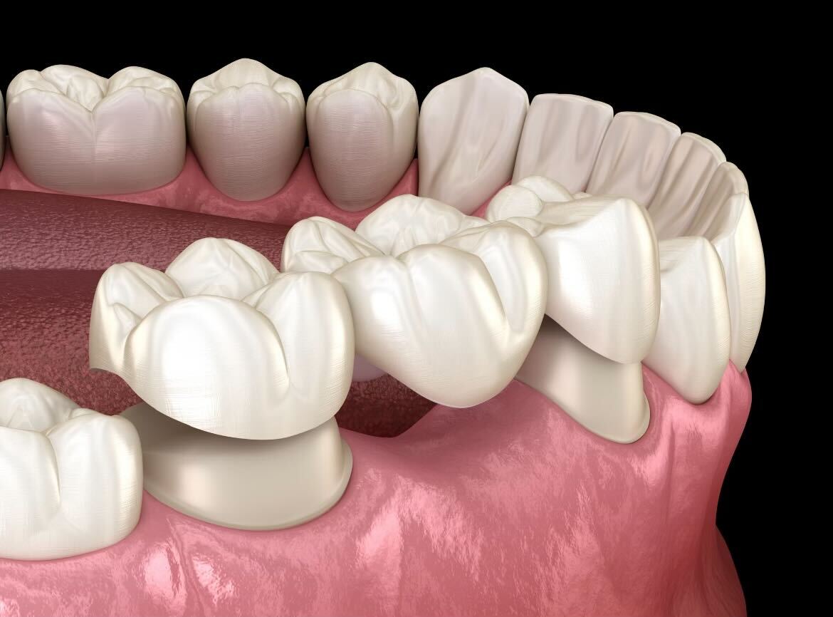 3D dental implant illustration showing tooth replacement on pink gum model against black background.
