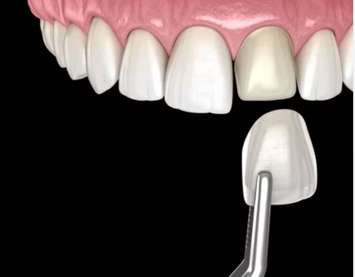 Dental crown being placed on tooth model showing cosmetic dentistry procedure