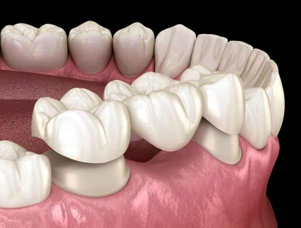 3D dental model showing natural teeth and gum tissue for restorative dentistry planning.