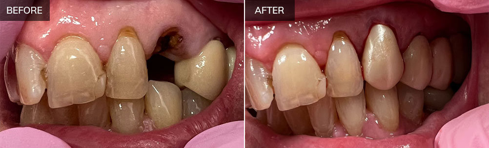 Before and after dental treatment showing tooth restoration and whitening results at Lombardi Dental.