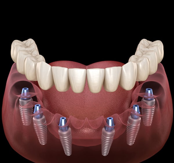 Dental implants illustration showing multiple titanium posts anchored in jawbone with prosthetic teeth.