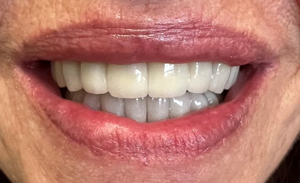 Close-up of a person's smile showing white teeth and pink lips in a dental context.