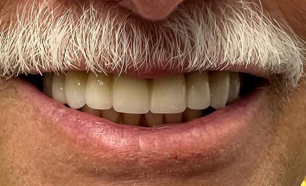 Close-up of man's smile displaying white teeth and facial hair against neutral background.
