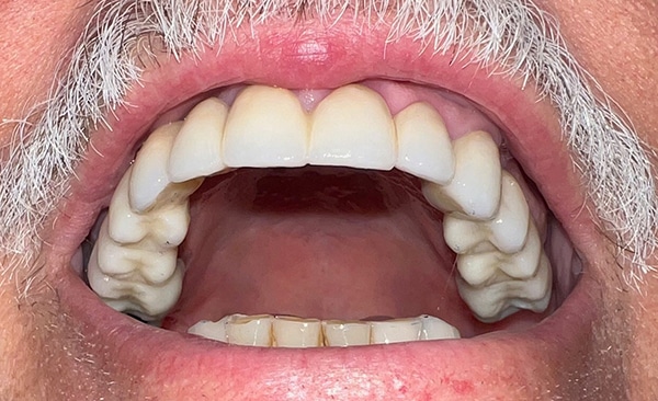 Close-up of open mouth displaying full dentures showing teeth alignment and fit.