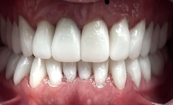 Close-up of white, healthy teeth showing upper and lower dental alignment and gum health.