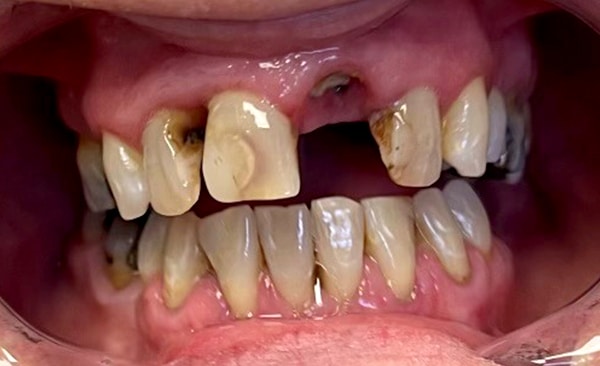 Close-up dental examination showing severe tooth discoloration, decay, and missing teeth in upper jaw.