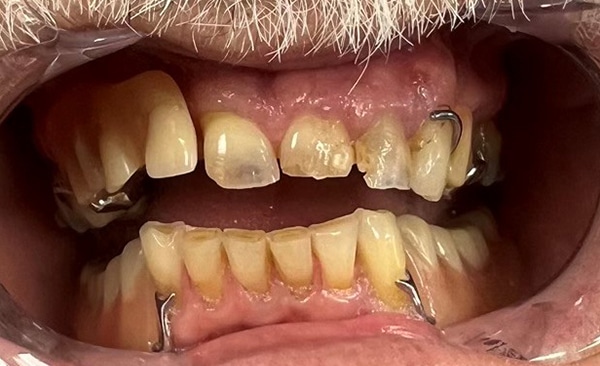 Close-up dental examination showing upper and lower teeth with visible discoloration and wear, intraoral view.