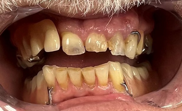 Close-up of dental implants and natural teeth showing orthodontic treatment progress in mouth.