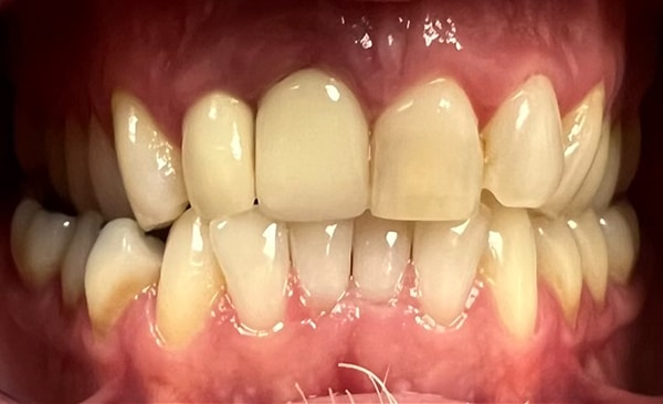 Close-up of upper and lower teeth showing natural tooth color and gum health in dental setting.