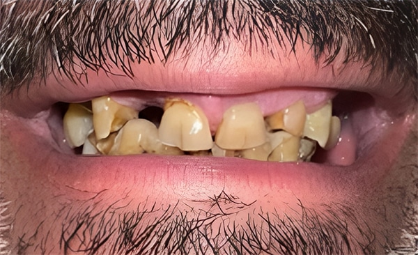 Close-up of deteriorated teeth showing decay and discoloration requiring dental care.