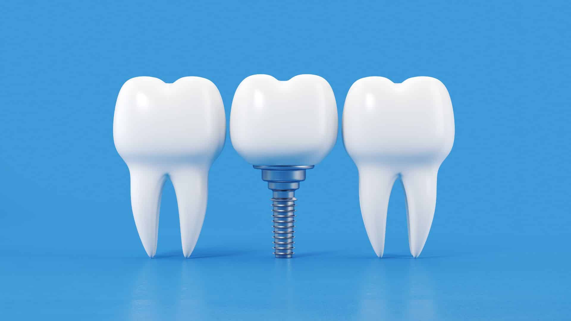 Featured image for “Transforming Smiles: The Power of Dental Implants in Sharpsville”