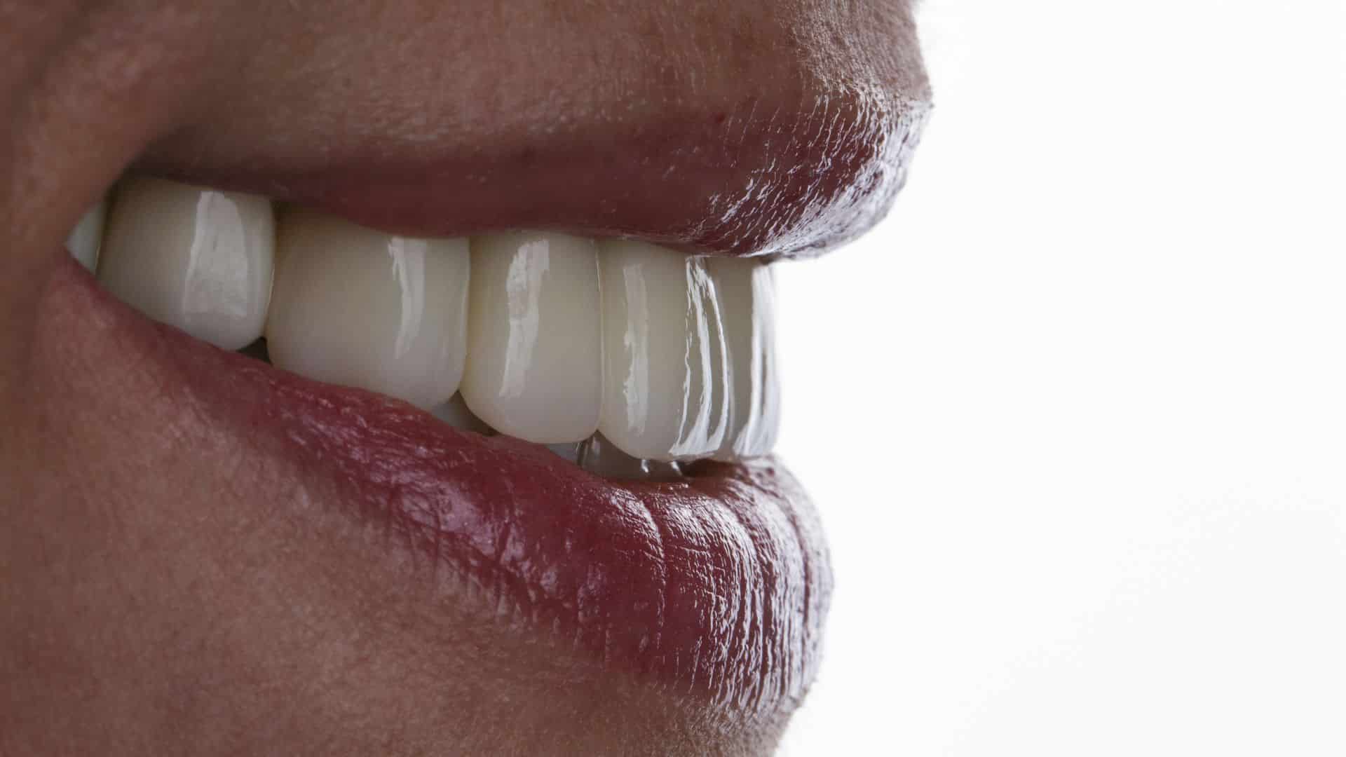 Featured image for “How Full Mouth Restoration Transformed My Smile”
