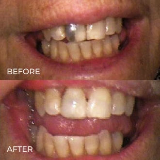 Before and after dental treatment showing improved tooth alignment and whitening at Lombardi Dental.