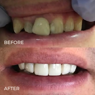 Before and after dental transformation showing discolored teeth restored to bright white smile.