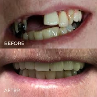 Before and after dental restoration showing improved tooth alignment and appearance at Lombardi Dental.