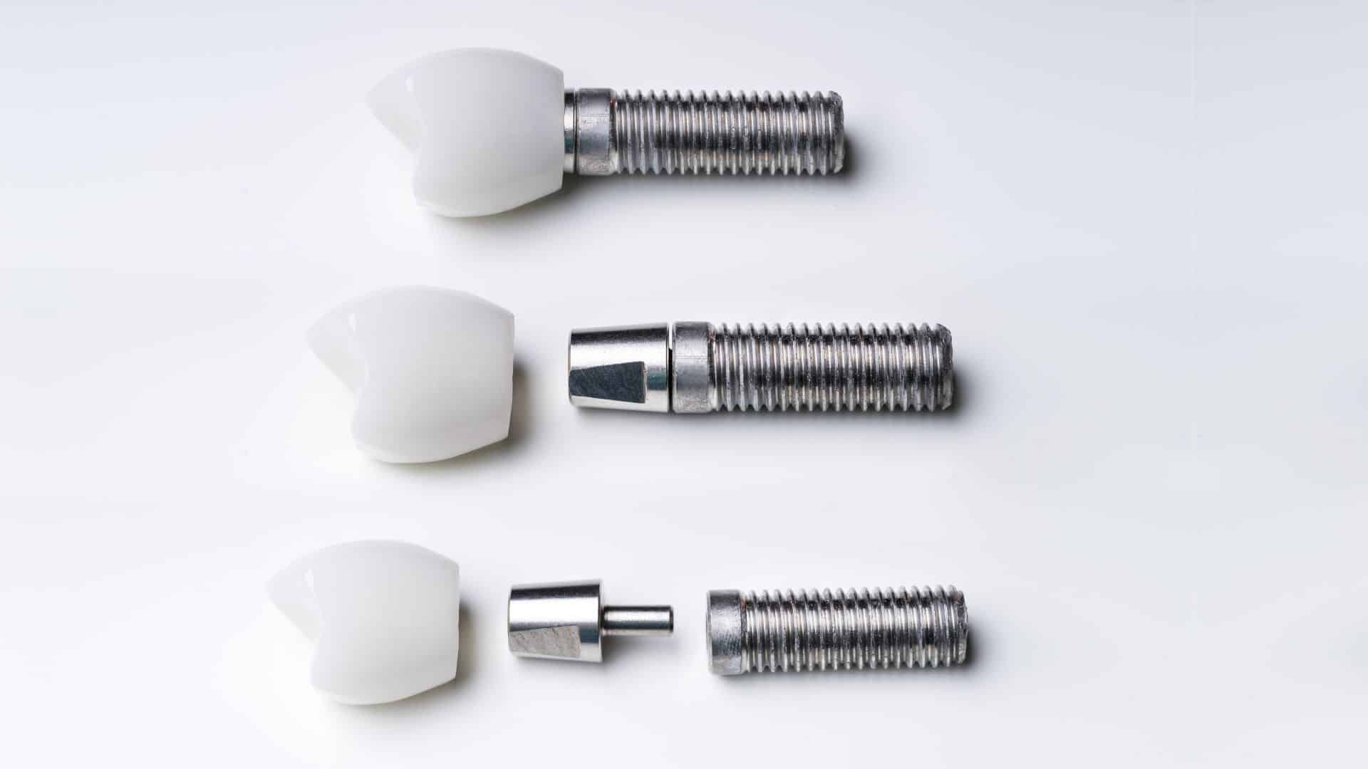 Featured image for “From Missing Teeth to Missing Nothing: A Guide to Dental Implants”