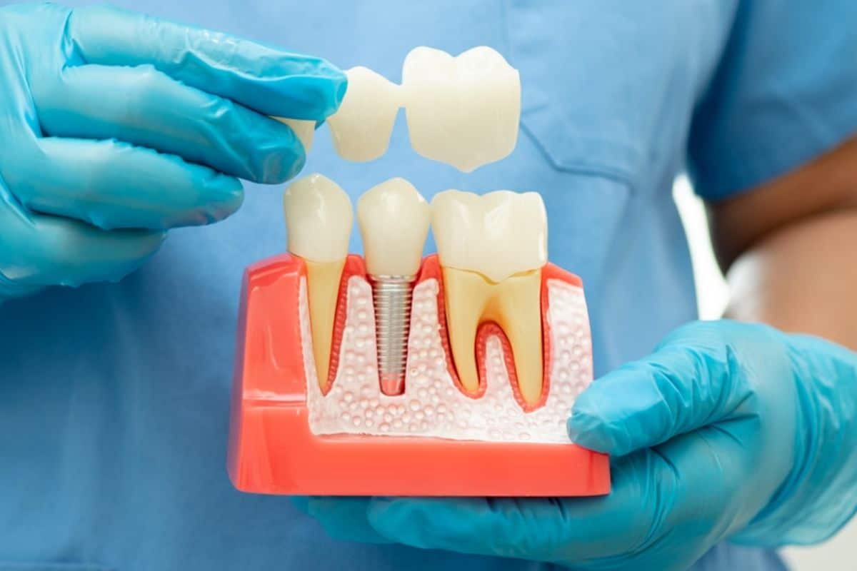 Featured image for “How Dental Implants Can Improve Your Health and Confidence”