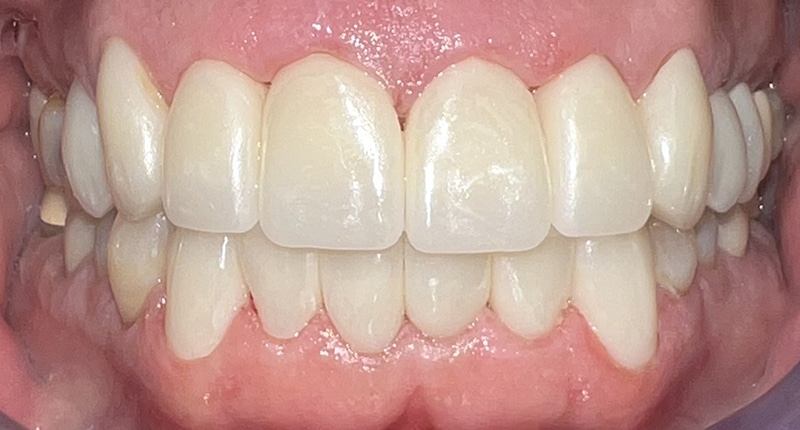 Close-up of bright white teeth showing perfect dental alignment and healthy gums in professional dental setting.