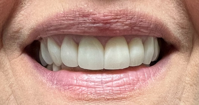 Close-up of a person's smile showing white, straight teeth and healthy gums in professional dental setting.