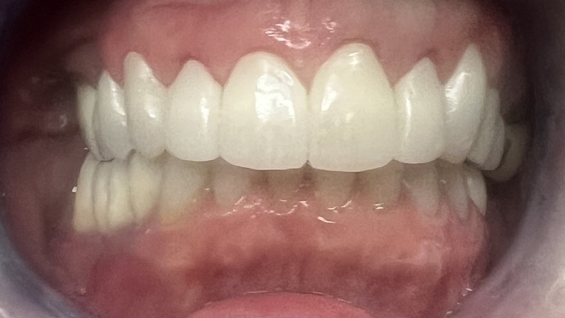 Close-up view of upper and lower dental veneers or crowns showing white teeth alignment and bite.