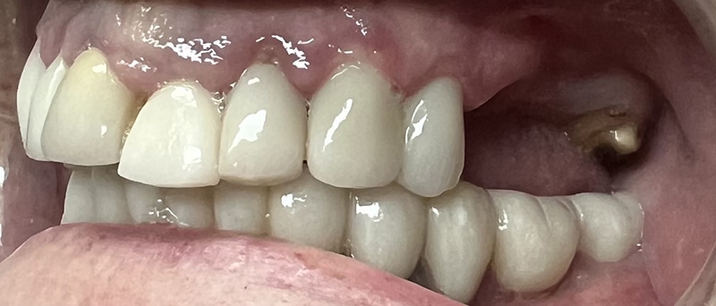 Close-up of dental work showing upper and lower teeth with crowns and restorations in mouth.