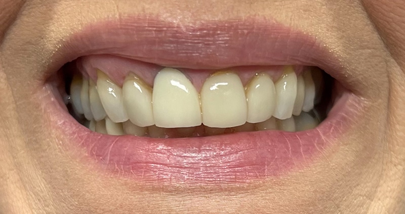 Close-up of a person's smile displaying white teeth and pink lips against skin tone background.