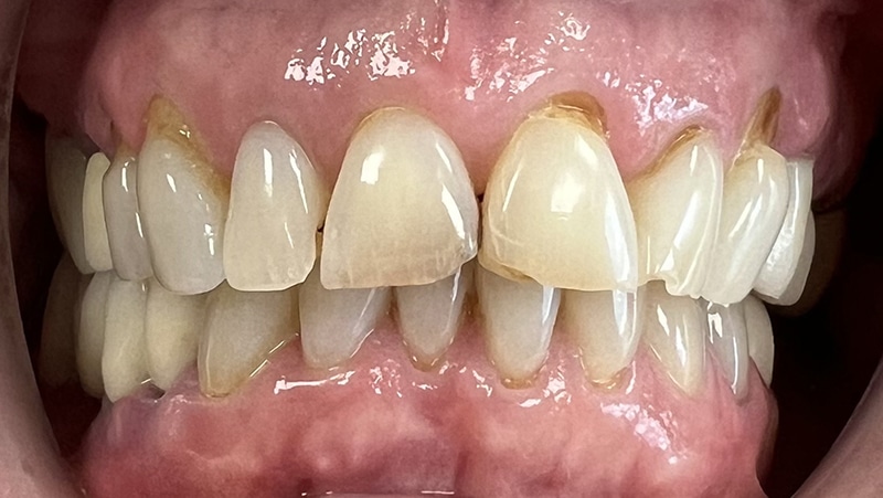 Close-up of dental veneers showing bright, uniform front teeth in a smile demonstration.