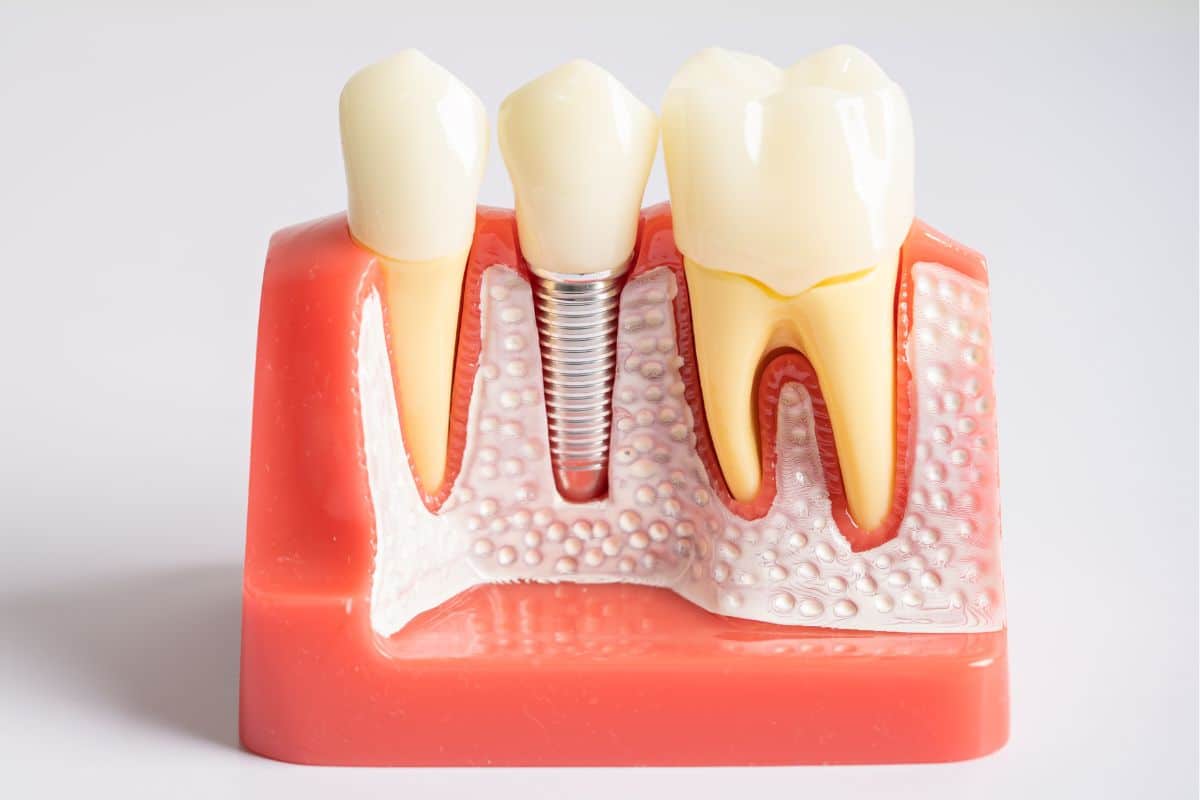 Featured image for “Can You Feel Your Real Teeth with Dental Implants?”
