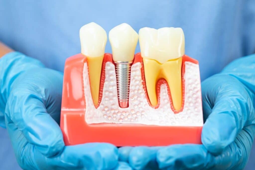 Can You Feel Your Real Tooth with Dental Implants?