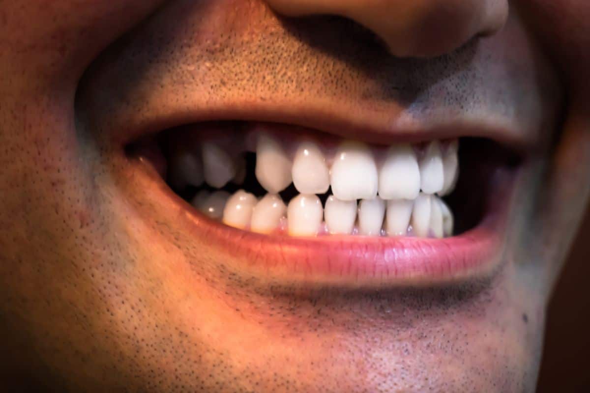 Featured image for “Can a Dentist Whiten Teeth Stained by Coffee or Smoking?”