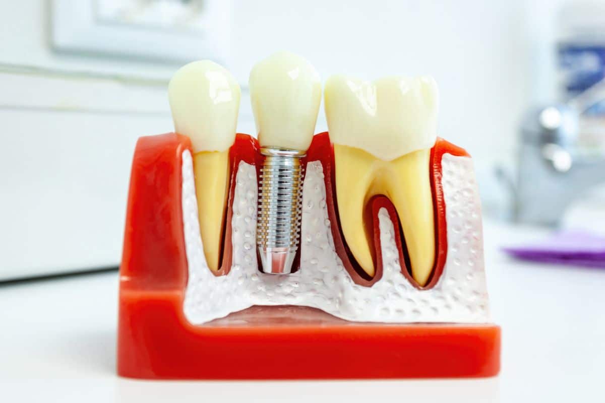 Featured image for “Signs Dental Implants Are Not Healing Well”