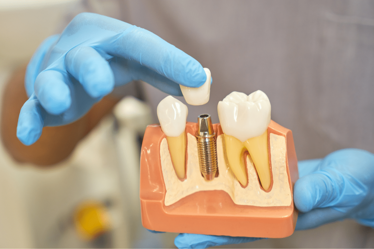 Featured image for “Lost a Tooth to an Injury? Exploring Dental Implant Replacement”