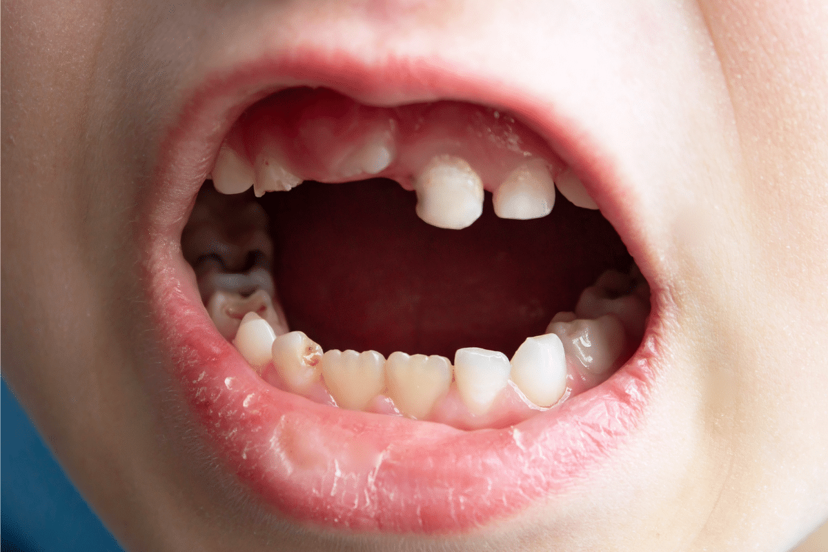 Featured image for “Baby Teeth Are Falling Out Early? When Your Child Needs a Dentist”